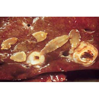 Liver Fluke